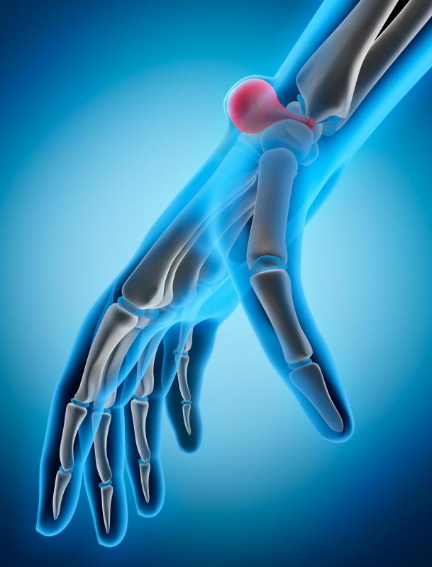 Carpal Bosse Schmerzhaft Diagnosis And Treatment Of Symptomatic 