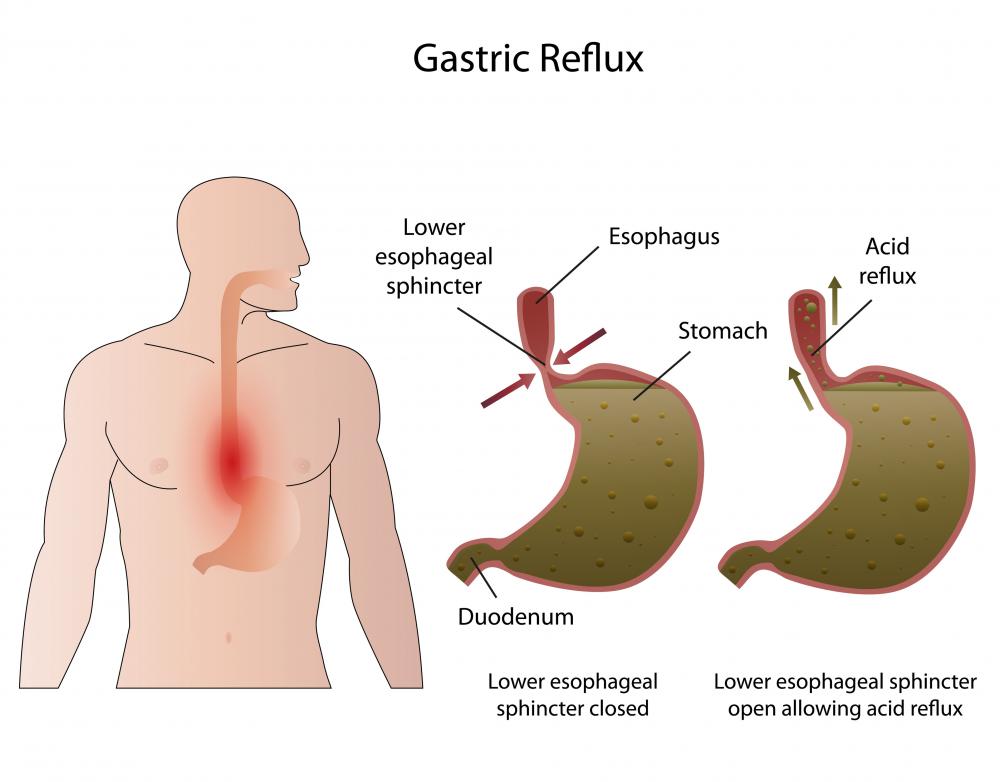 Post nasal drip diagram