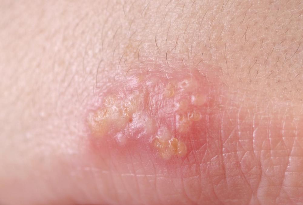 Bolha de água causada pelo herpes simplex tipo 1.