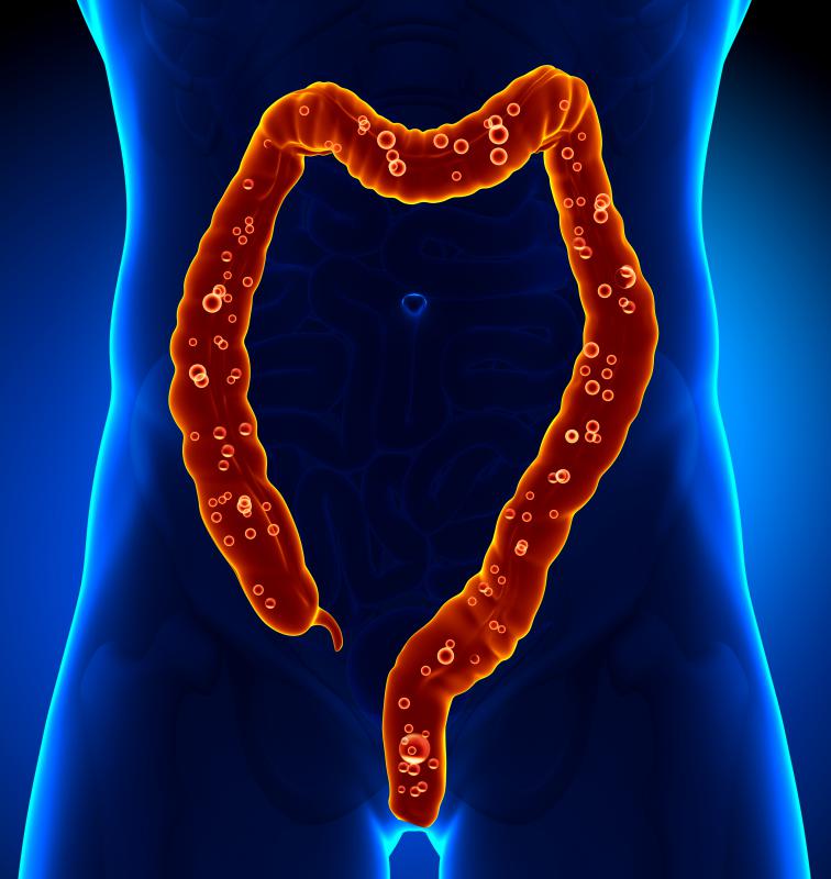 what-is-the-connection-between-diverticulitis-and-cancer