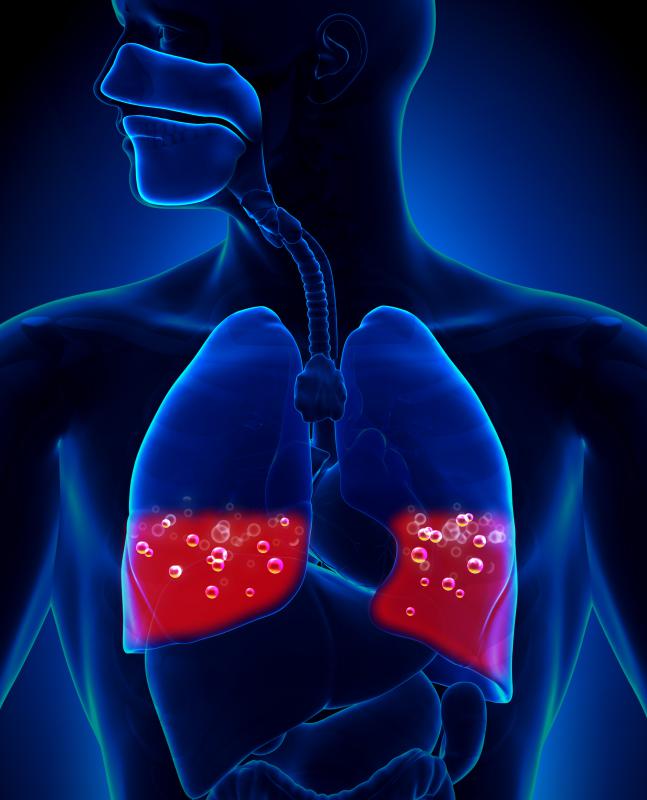 What is a Pulmonary Hemorrhage? (with pictures)