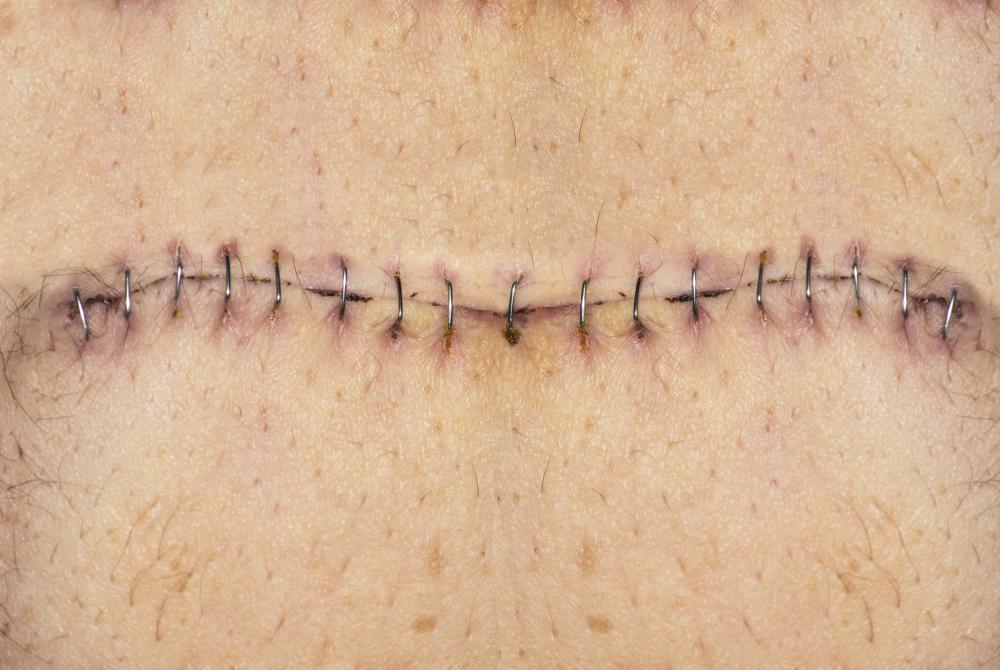 Should My Incision Be Red