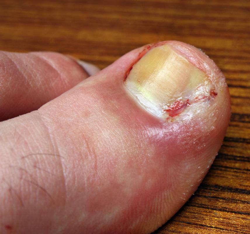 A bruised toenail may lead to infection if not properly treated.