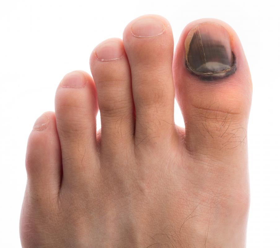 Treatment options for a bruised toenail are determined based on severity of the injury.