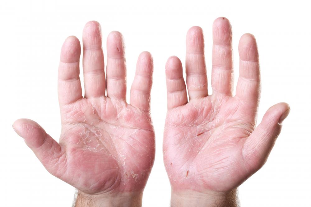 what-are-the-symptoms-of-poor-circulation-in-the-hands