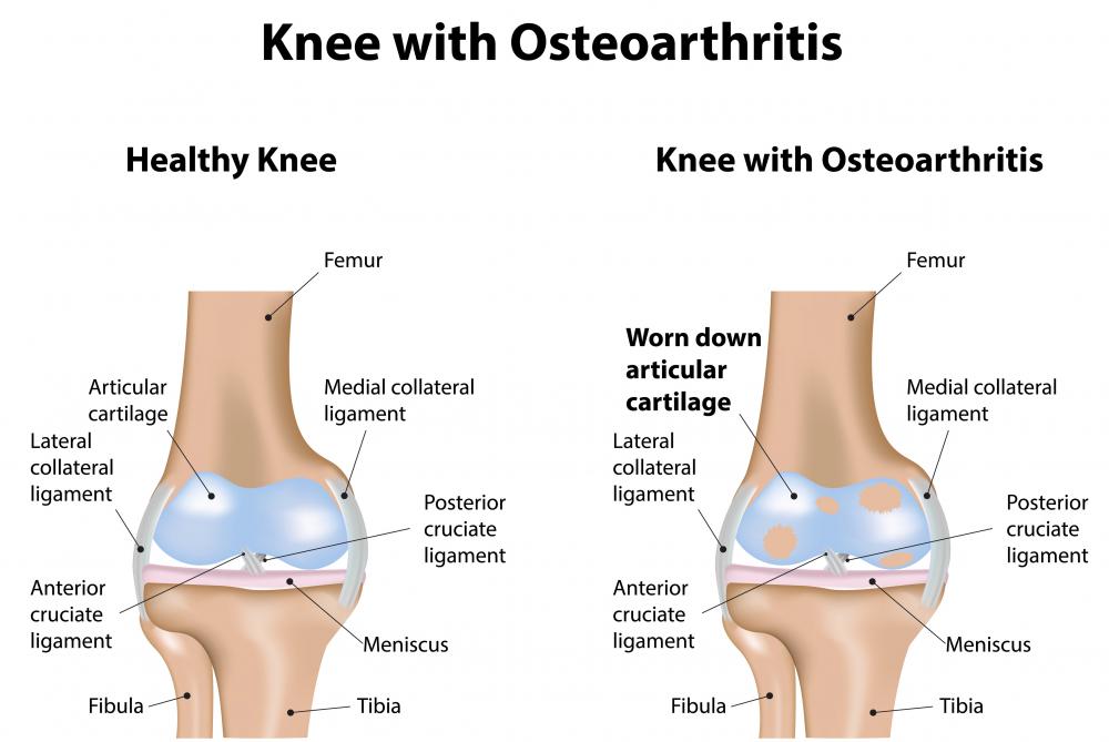 osteoarthritis glucosamine knee injection injections administered sometimes treat help