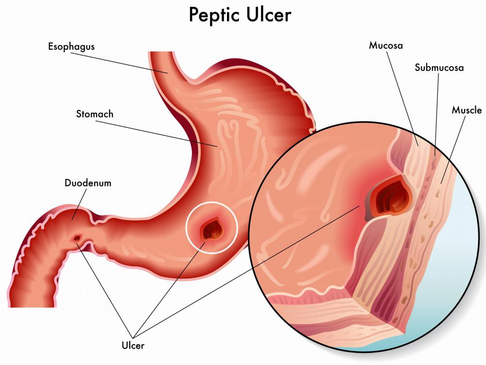 vagotomy and pyloroplasty