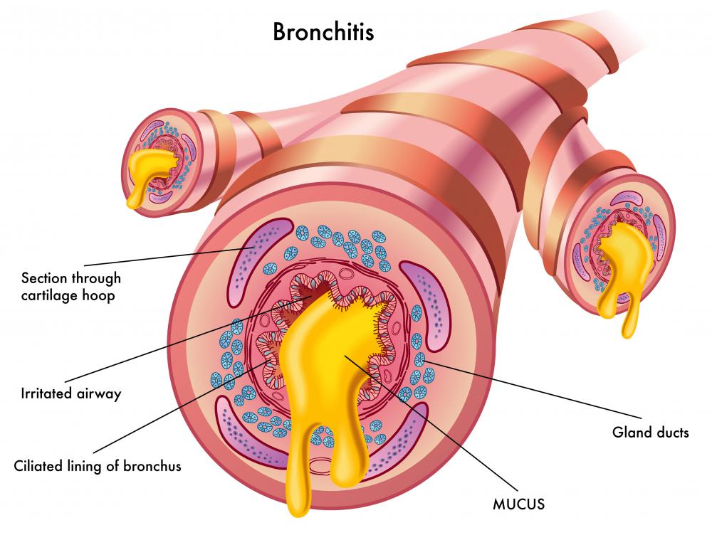 What Are The Common Causes Of Bronchitis With Pictures