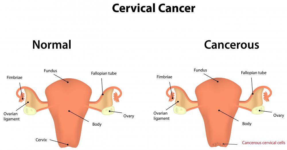 What Is Cervical Cancer Stage 3 With Pictures 4812