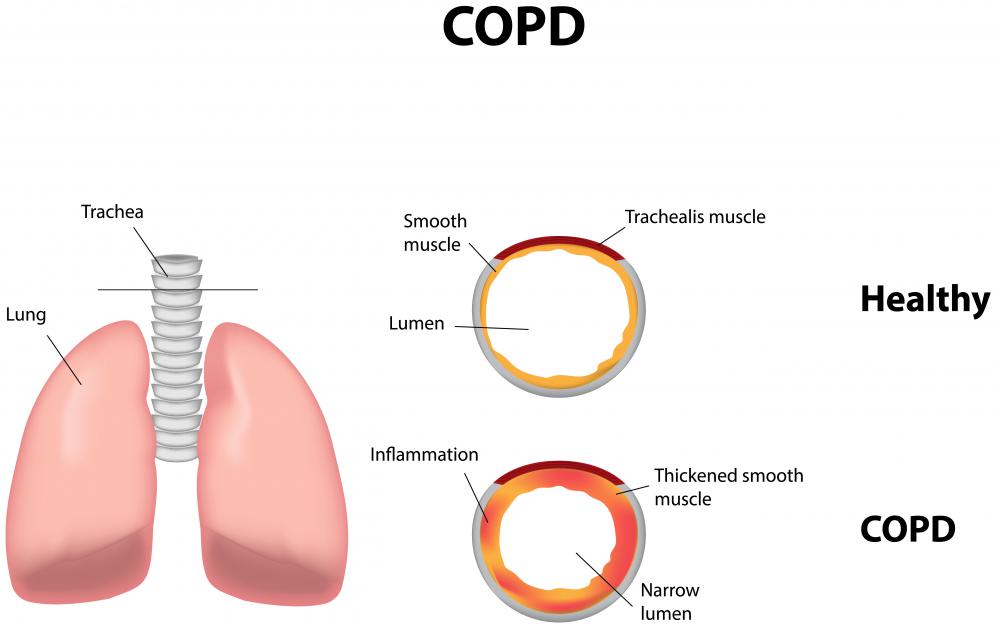 copd increase physiological dead space