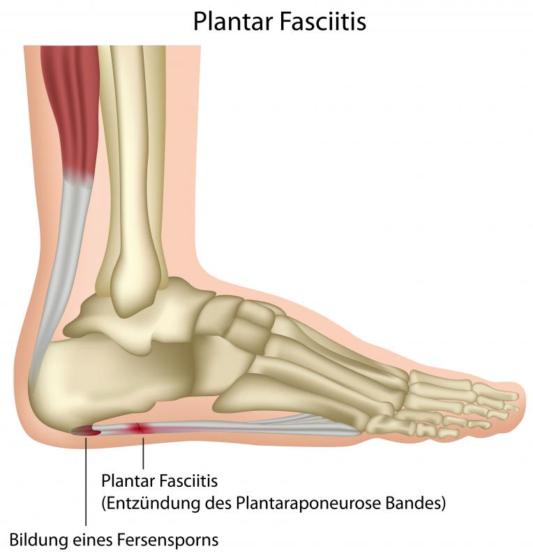 barefoot shoes and plantar fasciitis