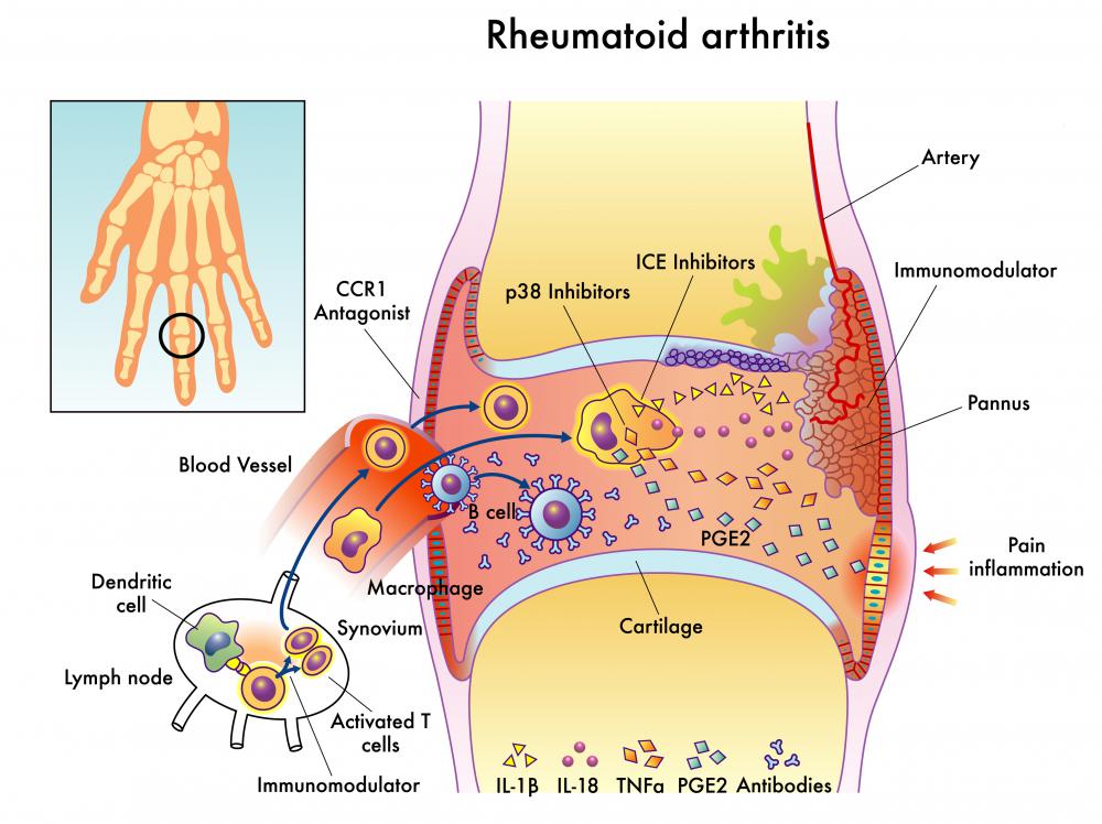 What is Collagen Disease? (with pictures)