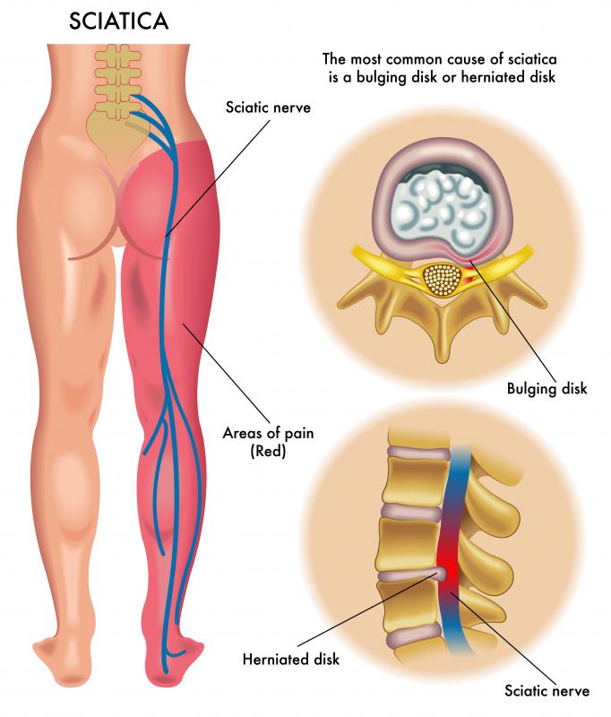 Sometimes caused by disc protrusion, sciatica can lead to pain and numbness down the leg.