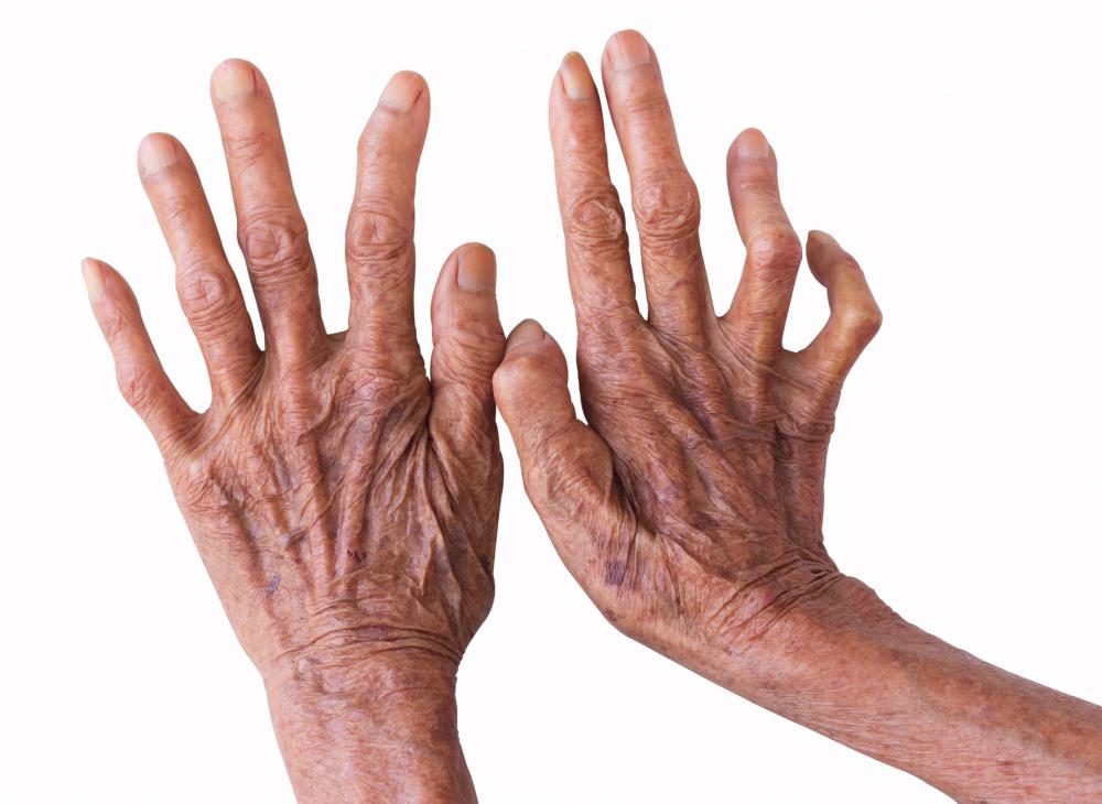 What are the Symptoms of Leprosy? (with pictures)