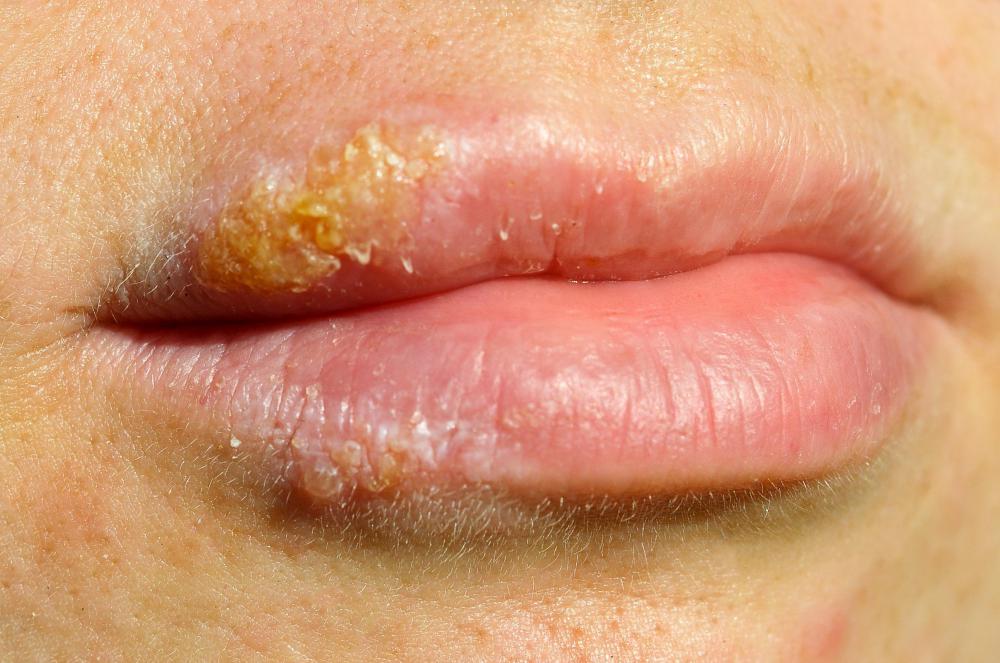 L'herpes simplex 1 è la causa del comune mal di freddo.