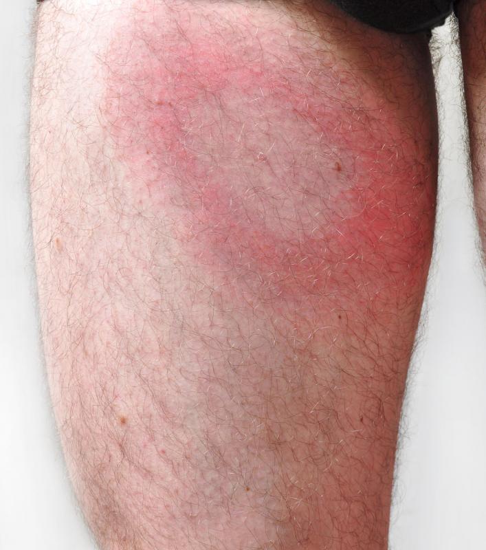 Ring Rash On Leg