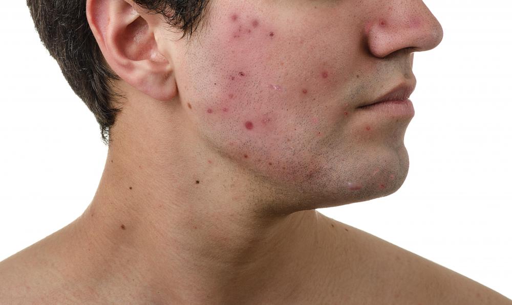 how-do-i-choose-the-best-severe-acne-treatment-with-pictures