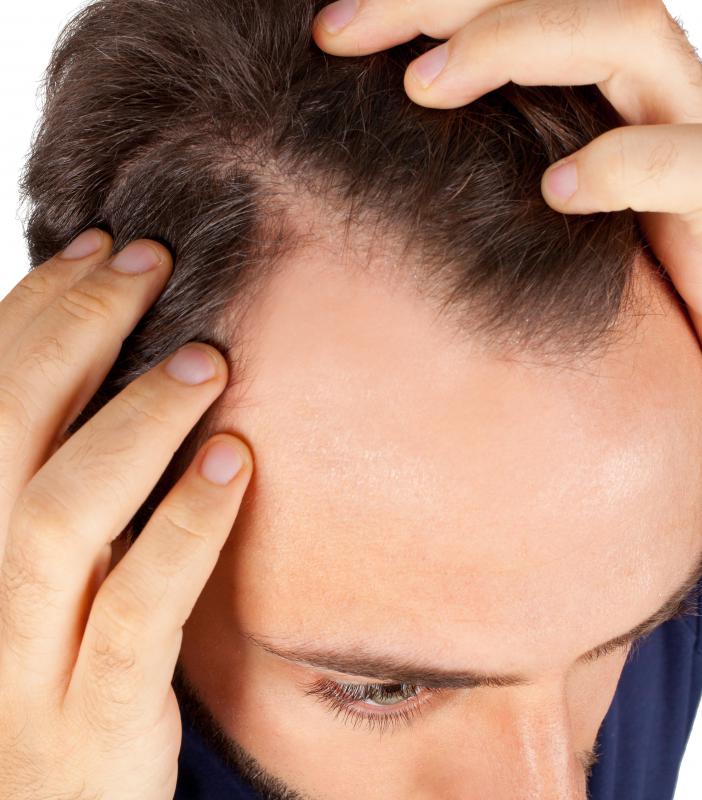 saw palmetto hair loss