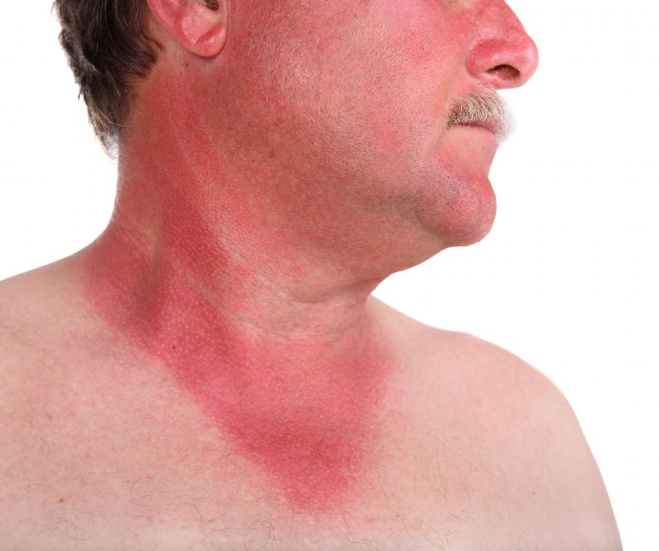 can-i-use-vinegar-on-a-sunburn-with-pictures