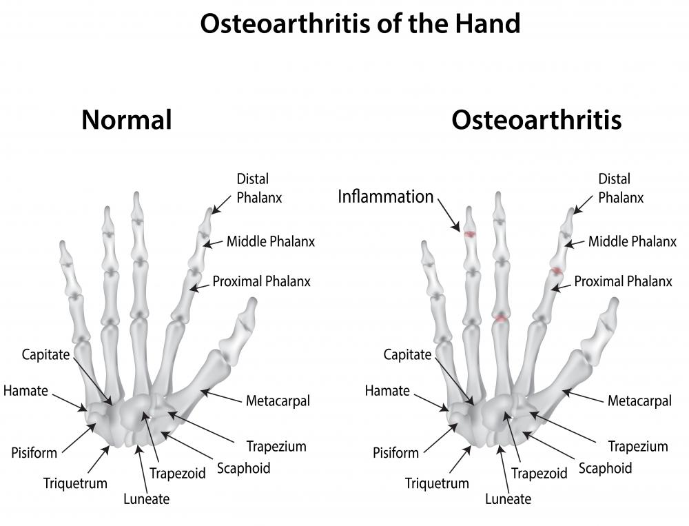 What Are The Symptoms Of Ehlers