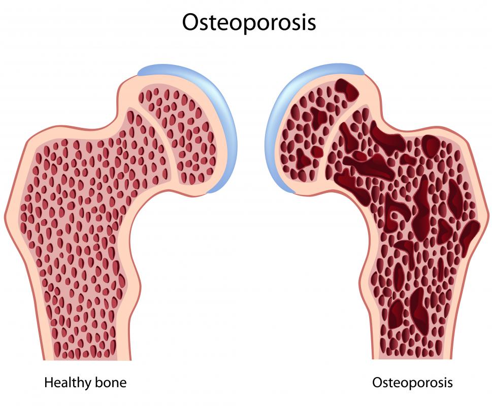 how to take osteoporosis medication