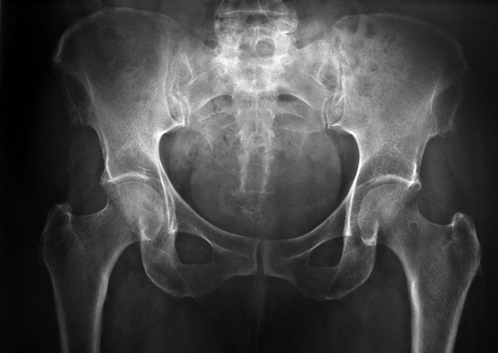 What is an Iliac Crest Graft? (with pictures)