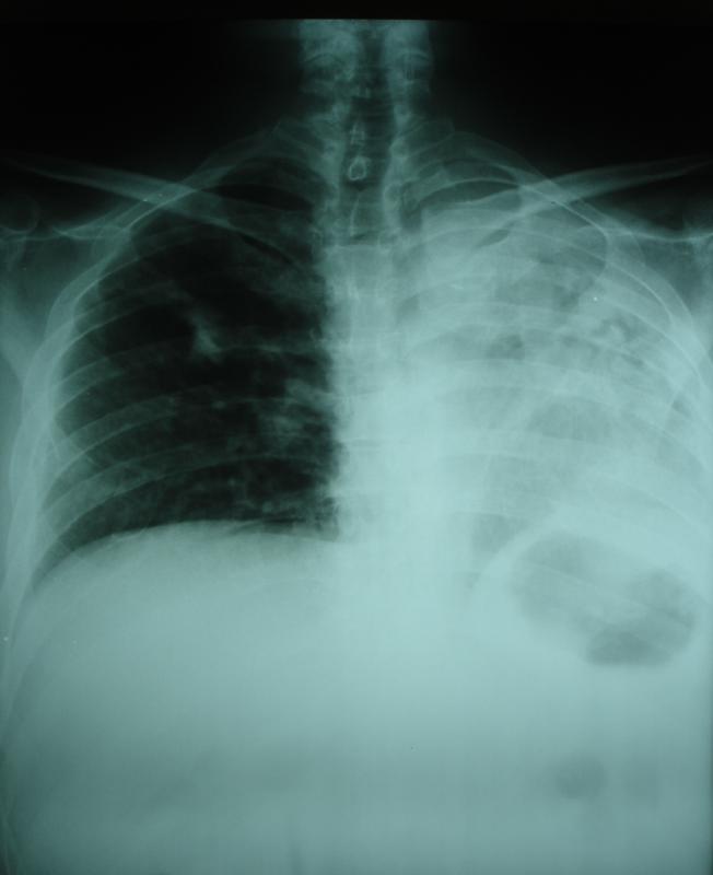 pleural fluid