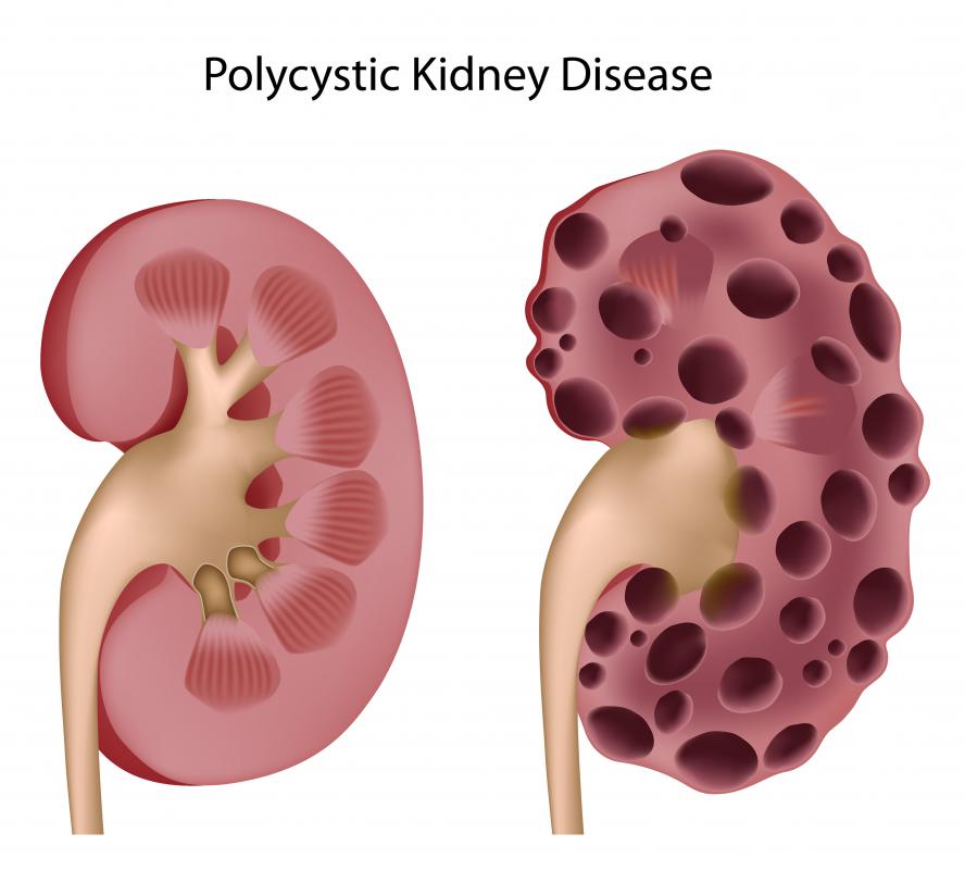 mass on kidney