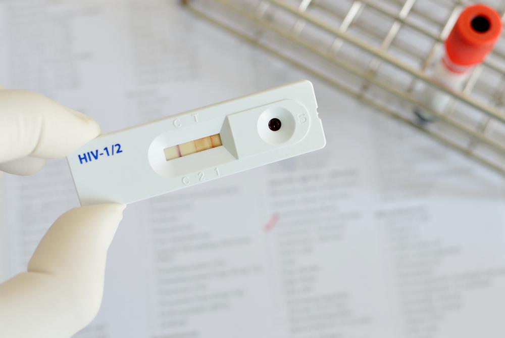 What is an ELISA HIV Test? (with pictures)