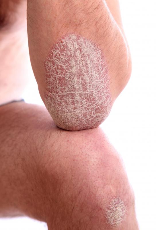 What Can Cause Patches Of Dry Skin