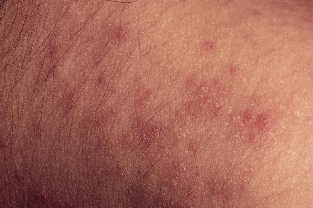 allergic skin rashes that itch