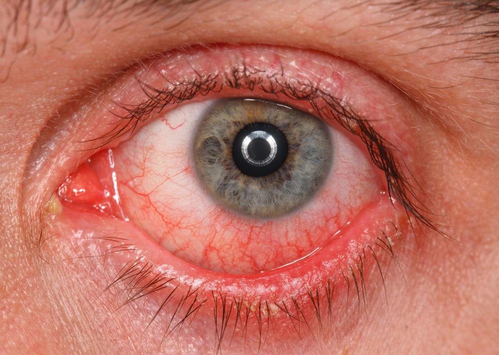 What Causes High Blood Pressure In The Eyes