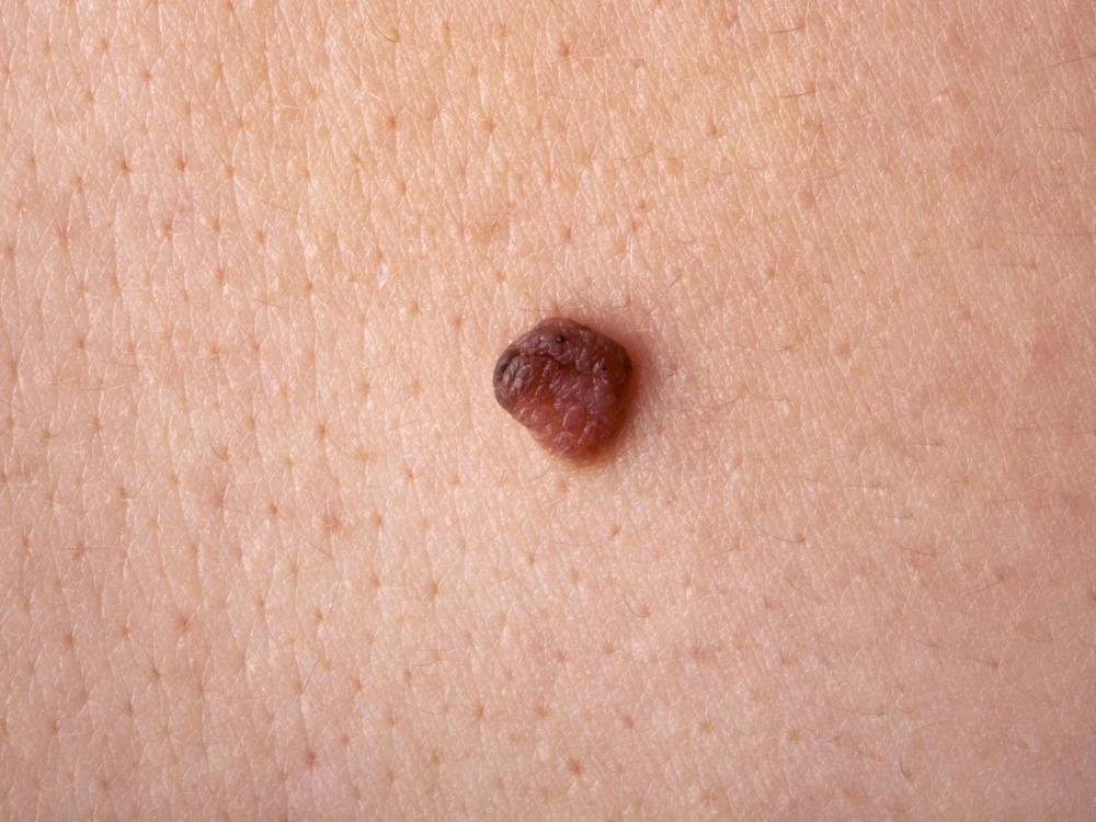 can-i-get-skin-cancer-from-moles-with-pictures