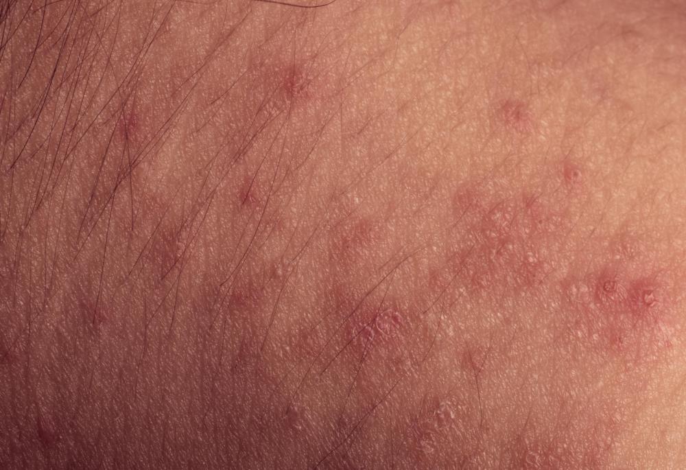 What Kind Of Viral Infection Causes A Rash