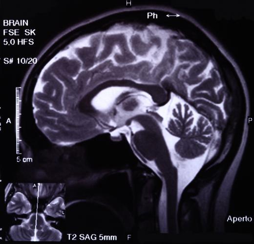 A SPECT scan can be used to trace blood flow through the brain.