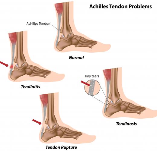 This diagram shows some common problems with the Achilles tendon, including tendinitis.