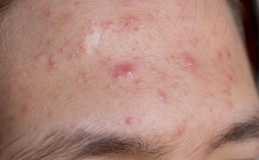 Pantothenic acid has been shown to be effective in treating stubborn acne.