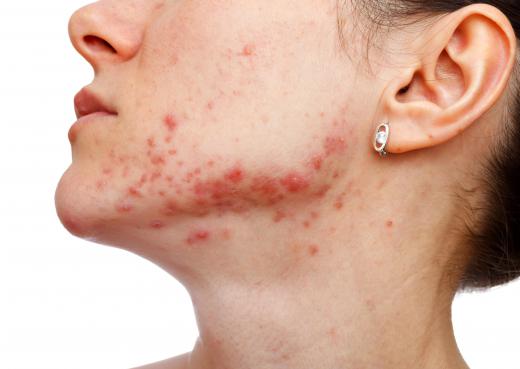 Acne is a possible side effect of Lamictal®.