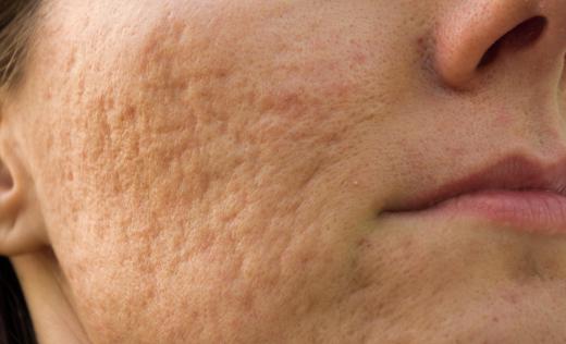 Acne can leave behind scars and marks.