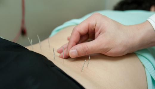 Fibromyalgia acupuncture can help patients cope with symptoms, but it is not a cure.