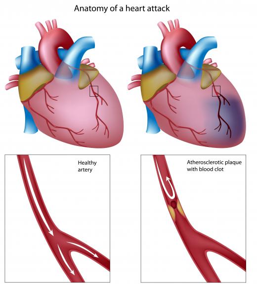 The anatomy of a heart attack. Cholesterol in the bloodstream can build up as atherosclerotic plaque.