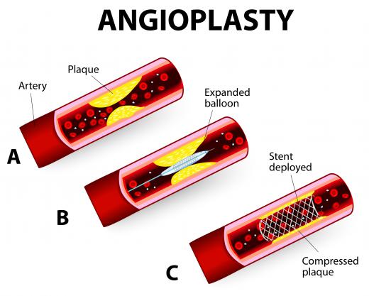 In some cases, patients with PAD require angioplasty to open up narrowed arteries.