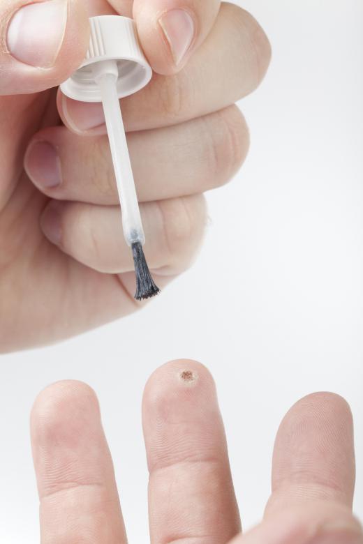 A dermatologist applying a wart removal medication to a patient.