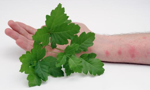 Exposure to poison oak causes allergic dermatitis.