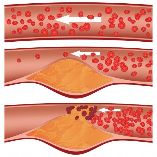 A normal artery, a partially clogged artery, and a fully clogged artery.