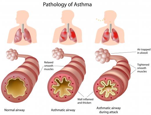 An illustration of the pathology of asthma.