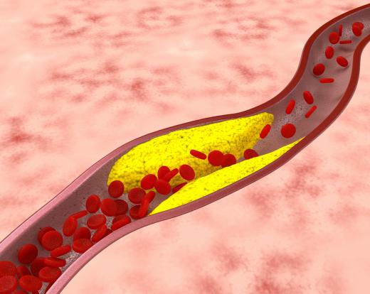 Abnormal clotting may be linked to atherosclerosis, which is the narrowing of the arteries due to plaque buildup.