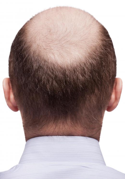 Male pattern baldness is a type of alopecia that is associated with aggressive hair thinning.