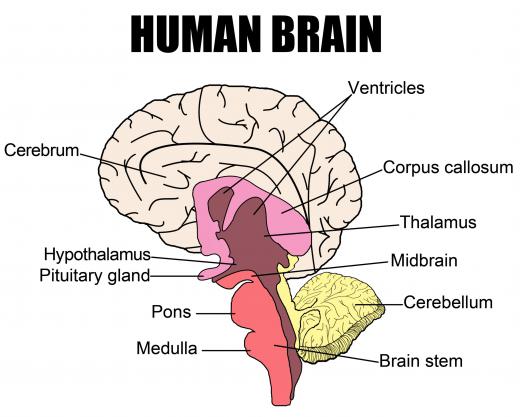 An intercranial hemorrhage can damage the brain.