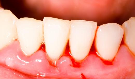 Periodontal disease often begins with bleeding gums.